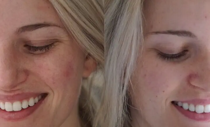 acne before and after LED face mask