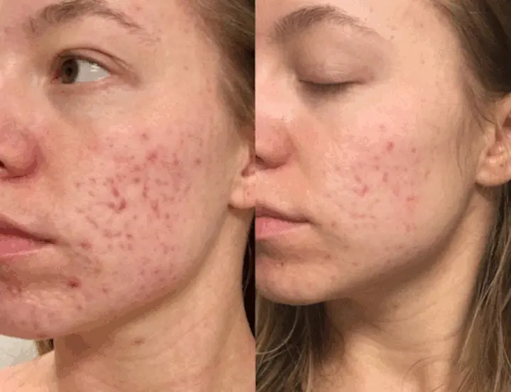 dermaplaning acne scarring before and after