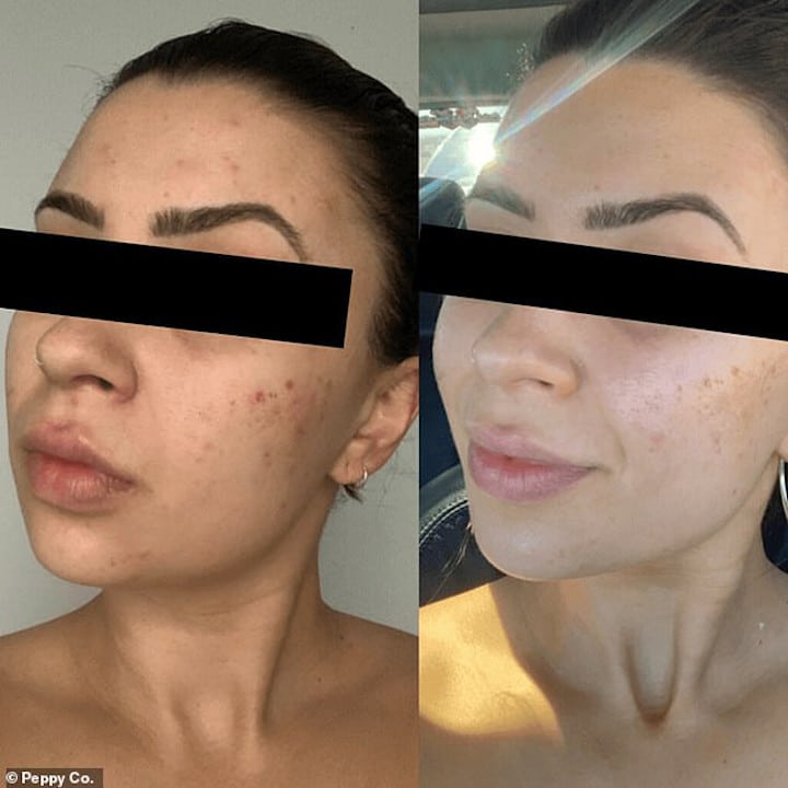 led face mask before and after acne scarring