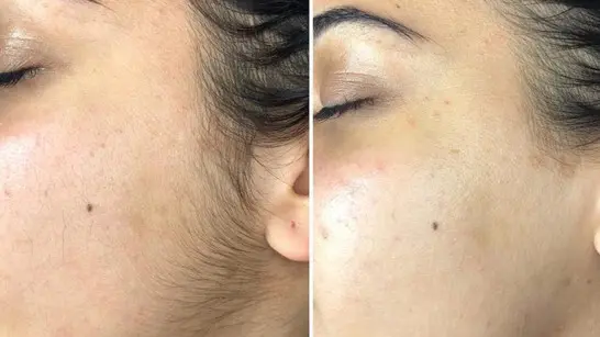 peach fuzz removal before and after