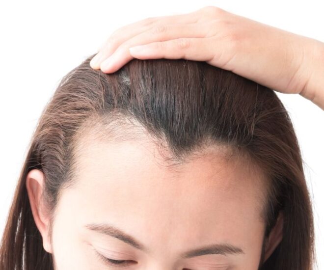 hair thinning in front
