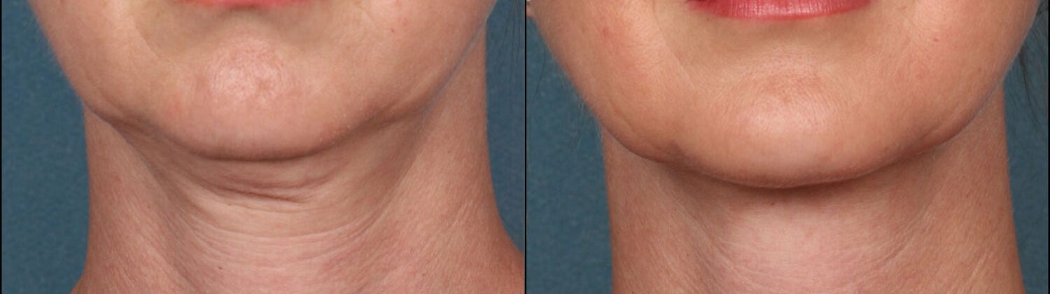 RF Microneedling vs Ultrasound Assisted Microneedling