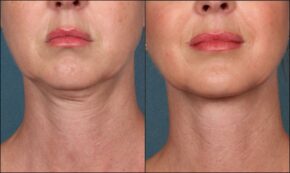 RF Microneedling vs Ultrasound Assisted Microneedling