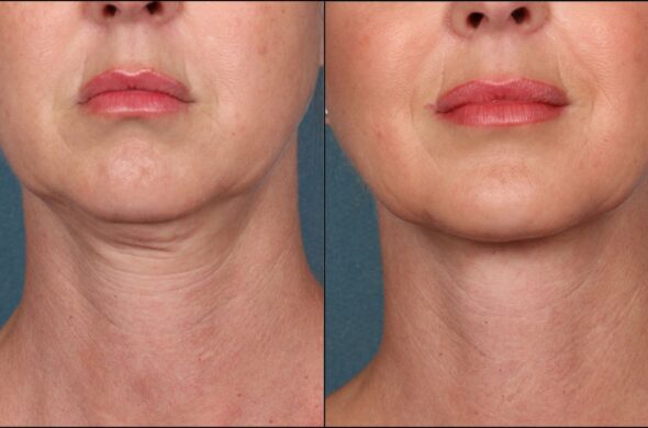 RF Microneedling vs Ultrasound Assisted Microneedling