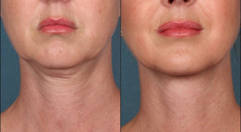 RF Microneedling vs Ultrasound Assisted Microneedling